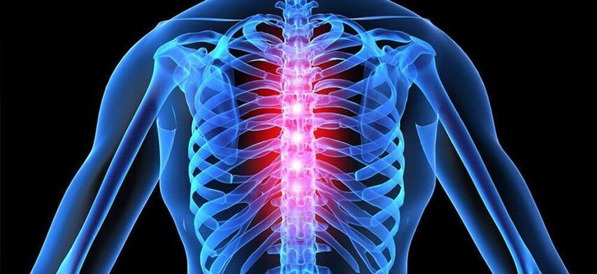 A dor aguda é característica da exacerbação da osteocondrose da coluna torácica
