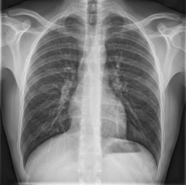 A osteocondrose da coluna torácica é diagnosticada por meio de radiografia