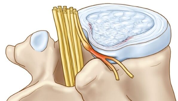 As saliências do disco intervertebral que ocorrem na osteocondrose torácica comprimem as terminações nervosas