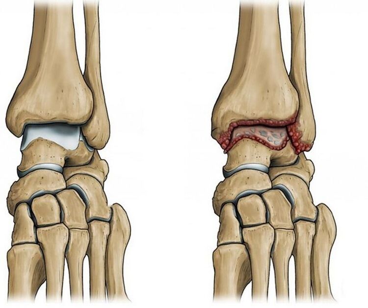 osteoartrite da articulação do tornozelo