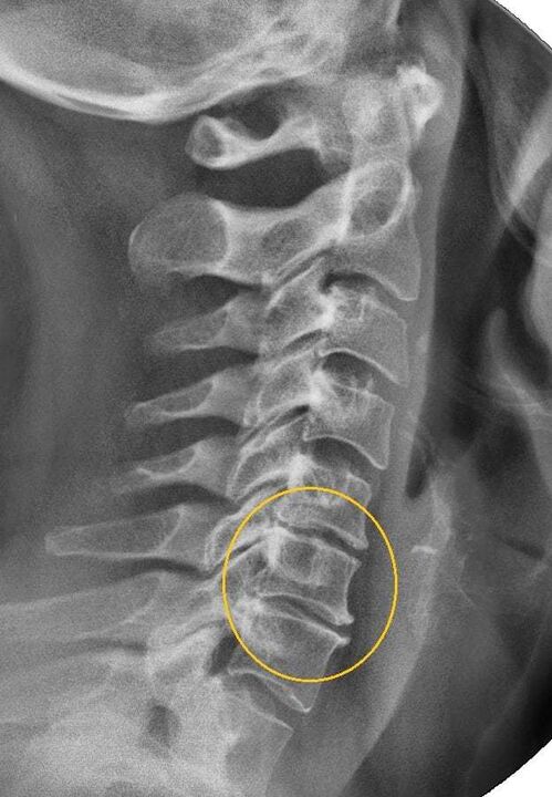 osteocondrose