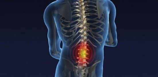 Dor nas costas com osteocondrose da lombar