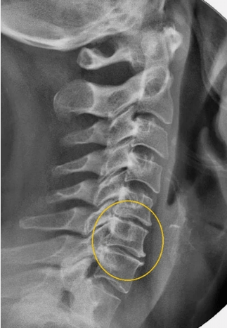 Osteocondrose da coluna cervical em uma raio X
