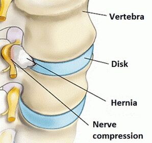 Osteocondrose da região cervical