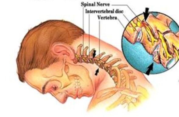 osteocondrose cervical
