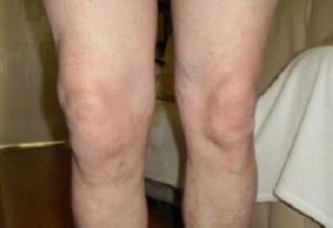 manifestações de artrose da articulação do joelho (1)