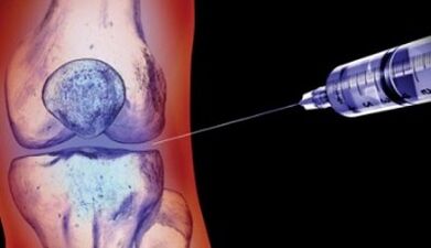 métodos de tratamento da artrose articular