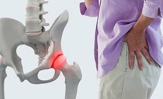 causas de artrose da articulação do quadril