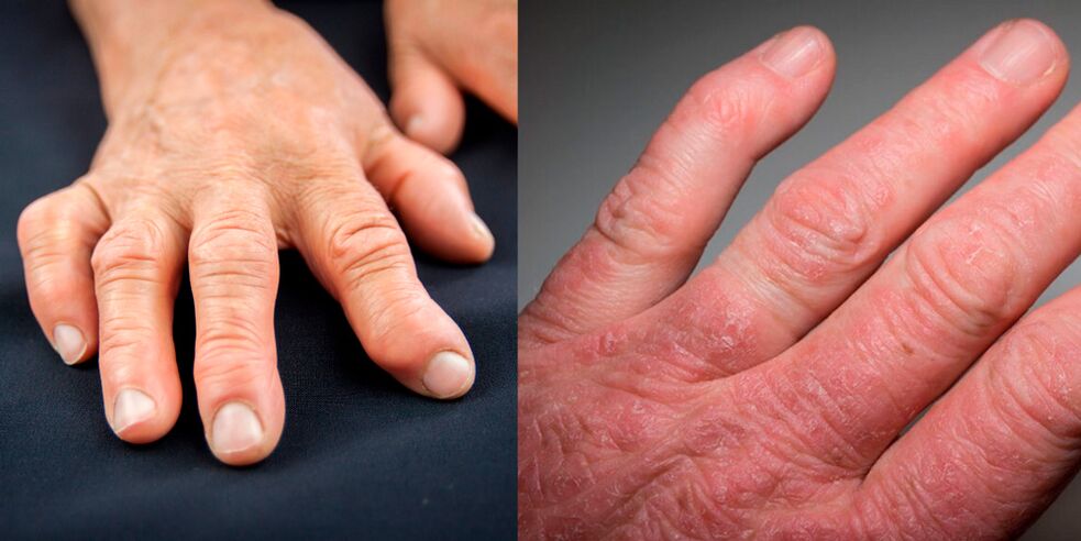 artrite reumatóide e psoriática das mãos