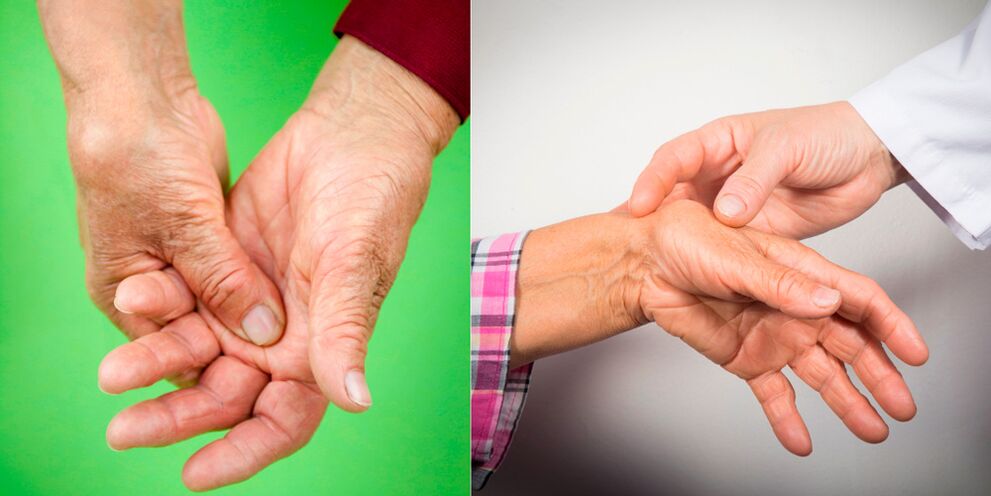 inchaço e dores doloridas são os primeiros sinais de artrite das mãos