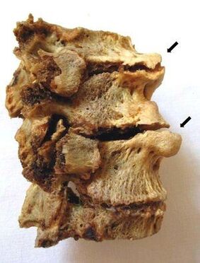 Seção vertebral afetada por osteocondrose