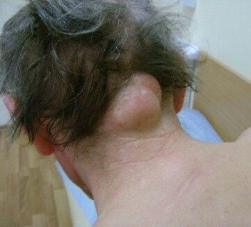 neoplasia como causa de dor no pescoço