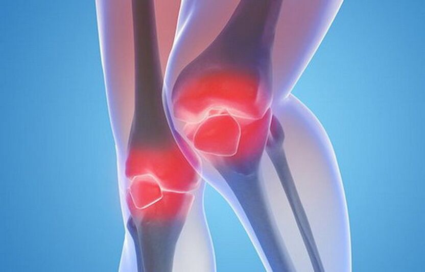 artrose das articulações do joelho