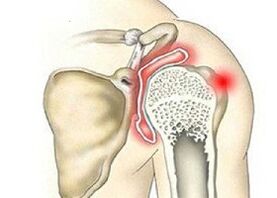 destruição da articulação do ombro com artrose