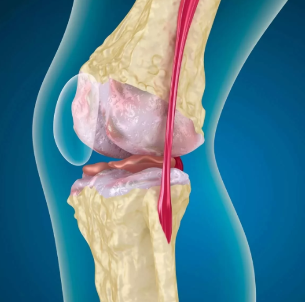 A artrose do joelho
