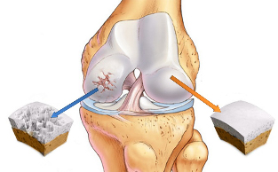 a artrose do joelho
